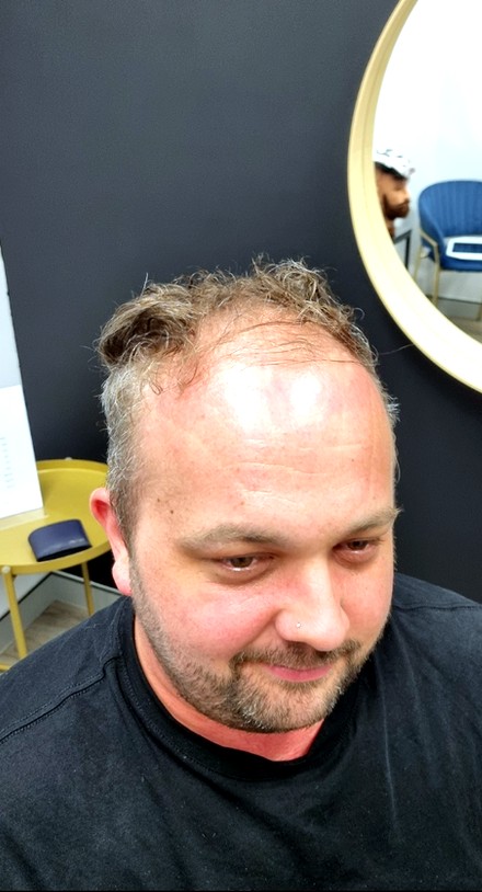 Client before their Tuffs hair system