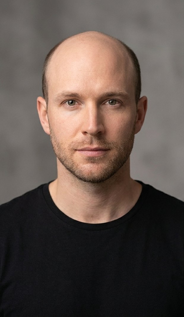 Before — a thinning crown and receding hairline