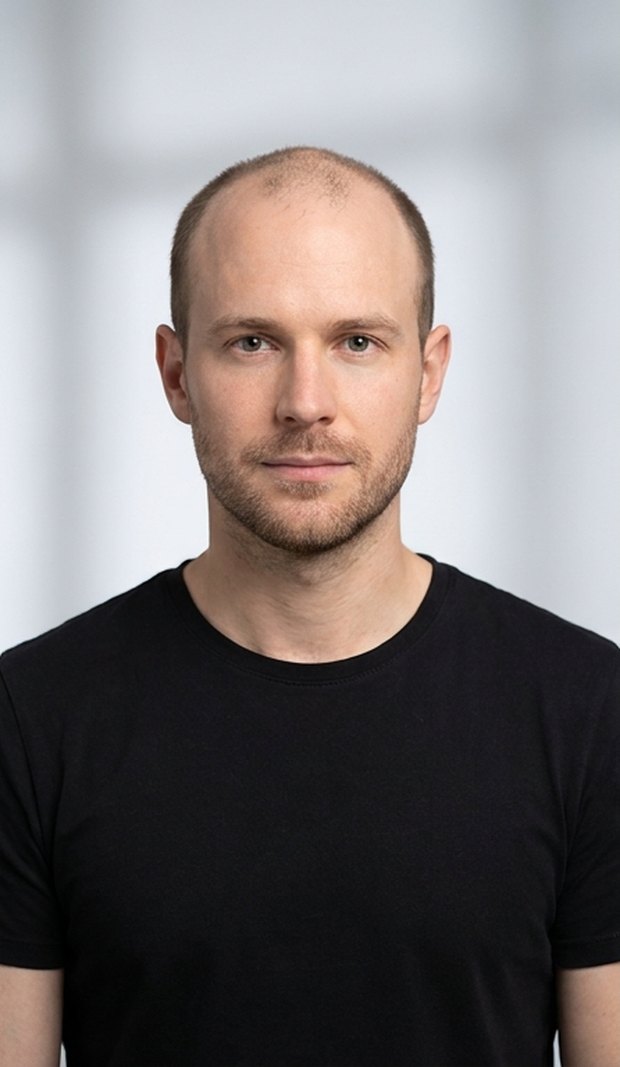 Before — a thinning crown and receding hairline