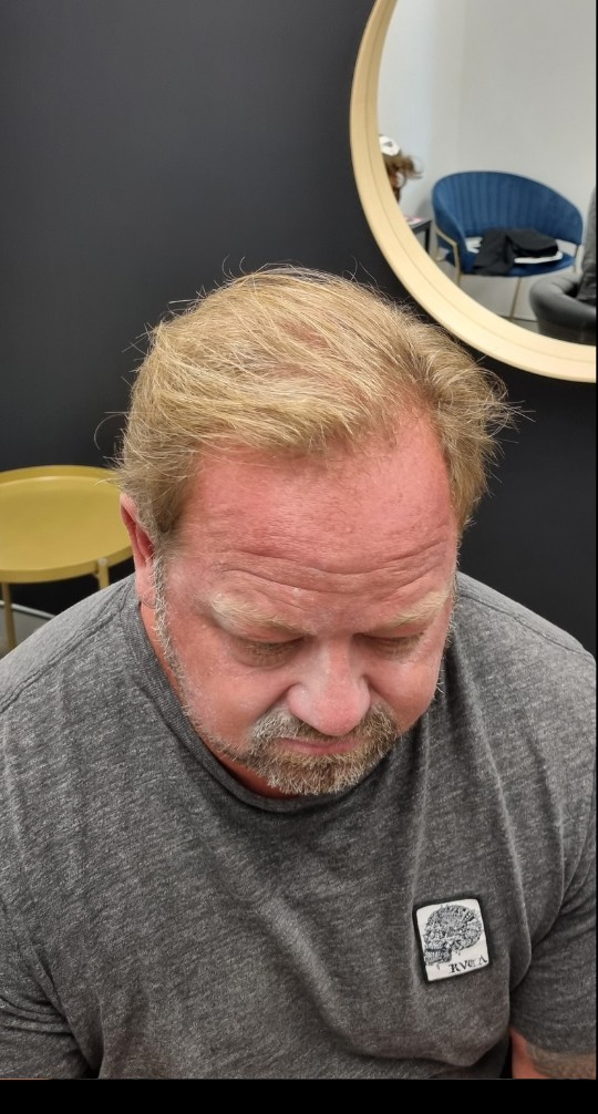 Client before their Tuffs hair system