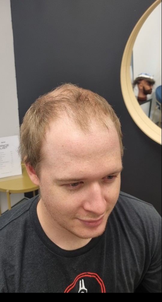 Client before their Tuffs hair system