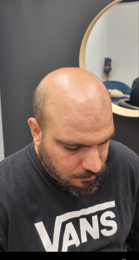 Client before their Tuffs hair system