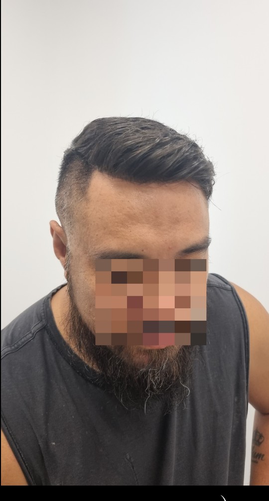 The same client after their Tuffs hair system
