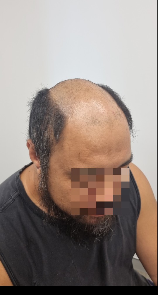 Client before their Tuffs hair system