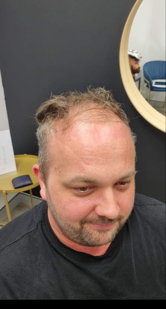 Client before their Tuffs hair system